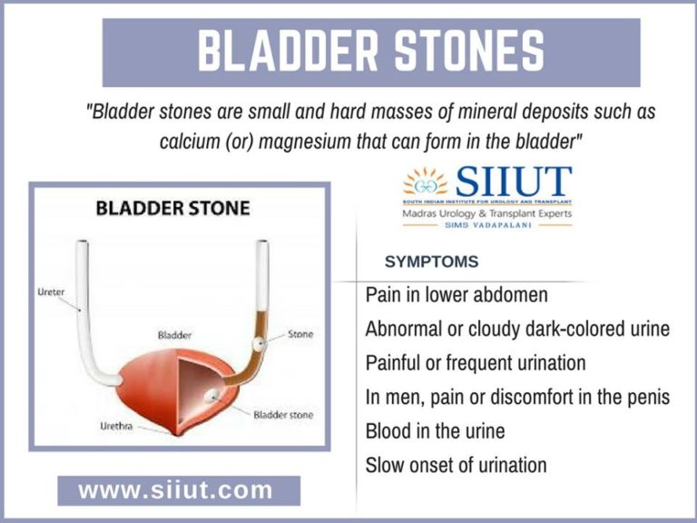 Treatment for Bladder Stones