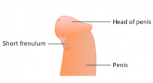 Frenuloplasty