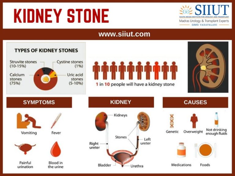 Kidney Stones